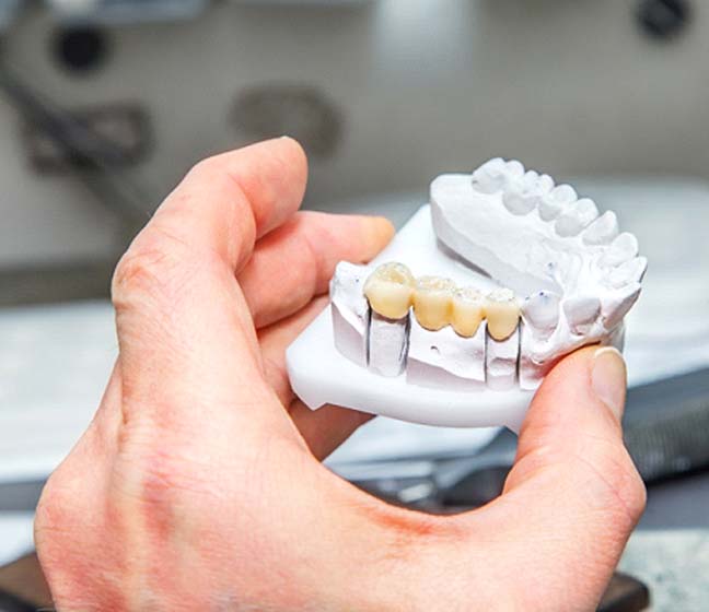 Dental bridge in Dallas on model of jaw