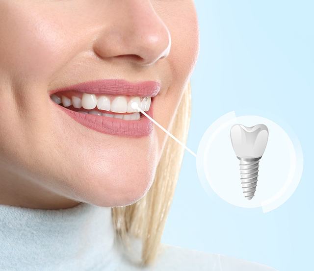 woman smiling with dental implant graphic