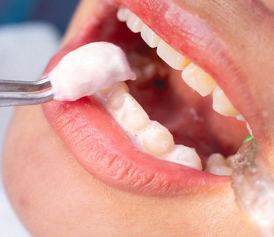 Closeup of fluoride gel being applied to someone’s teeth