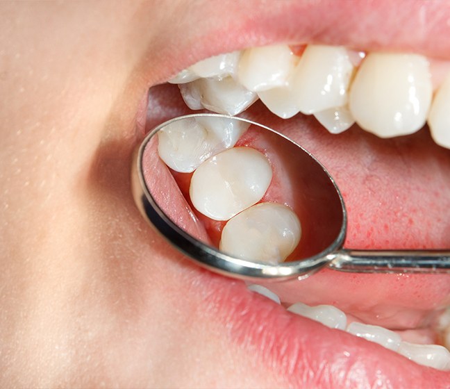 Dentist examining smile after tooth colored filling restorative dentistry