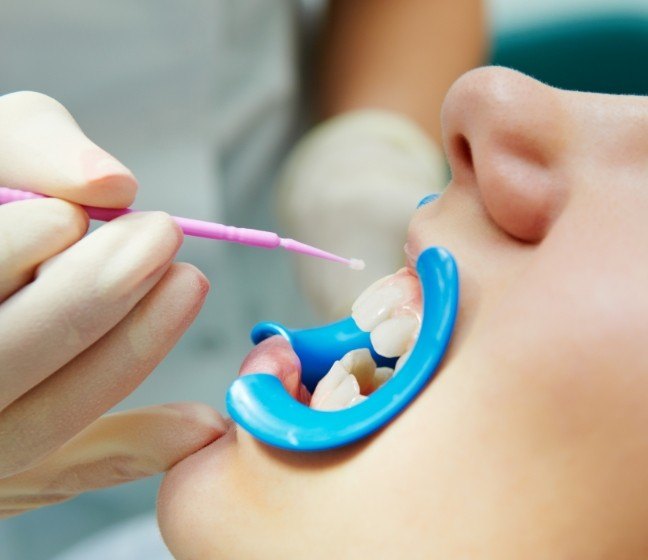 Patient receiving fluoride treatment