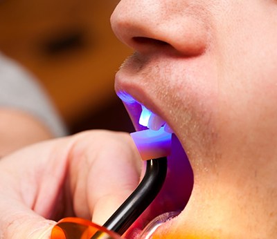 Close-up of dental bonding; cosmetic dentistry in Dallas, TX