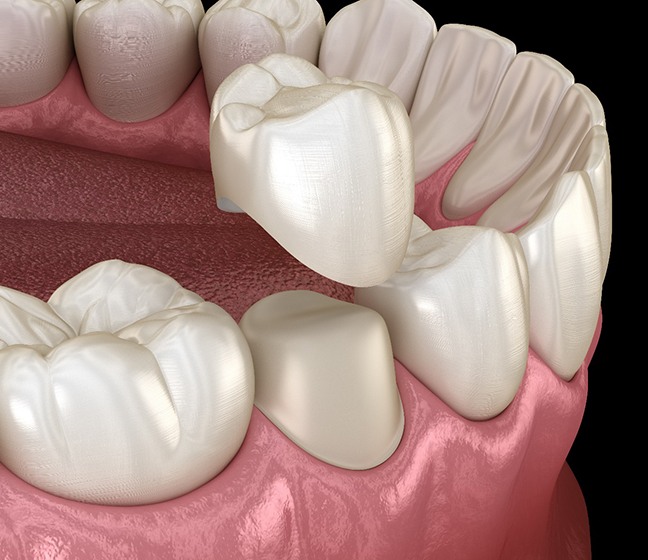 3D illustration of a dental crown