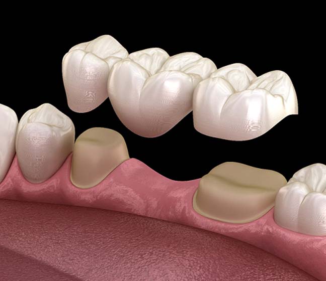 Digital illustration of tradition dental bridge in Dallas