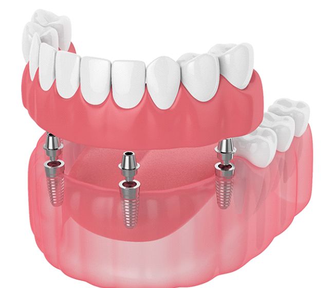Digital illustration of dental implant dentures in Dallas