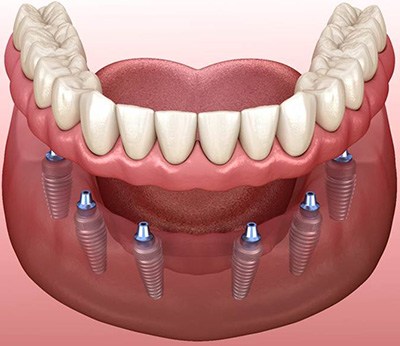 Digital illustration of implant dentures in Dallas