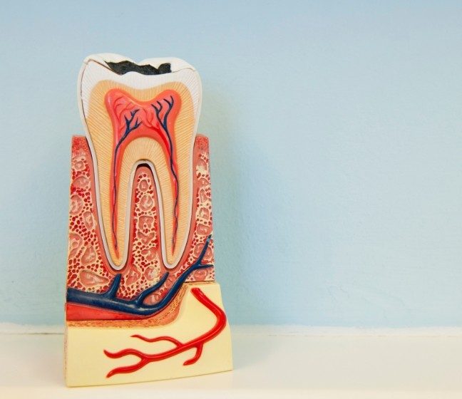 Animated tooth in need of root canal therapy