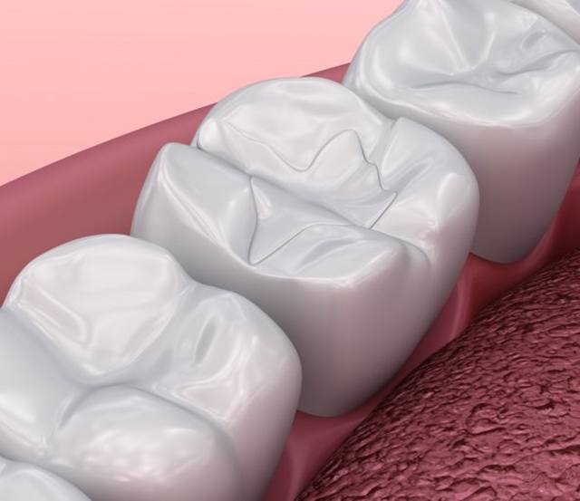 a 3 D digital illustration of tooth colored fillings