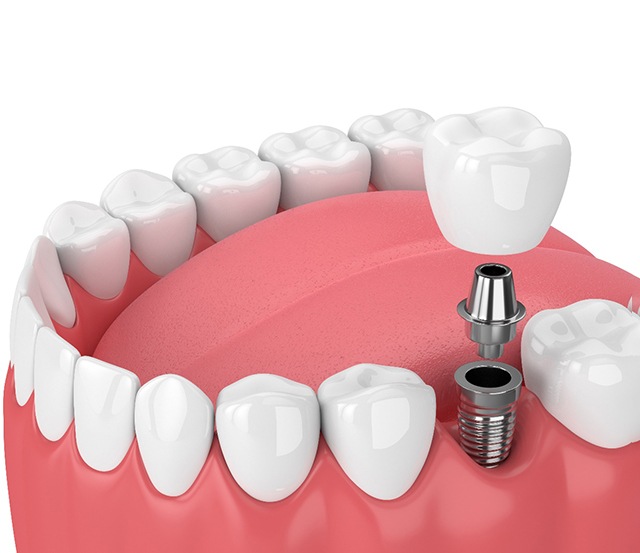 3d model of dental implant