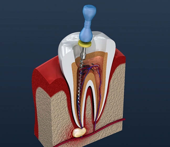 illustration of root canal process in Dallas