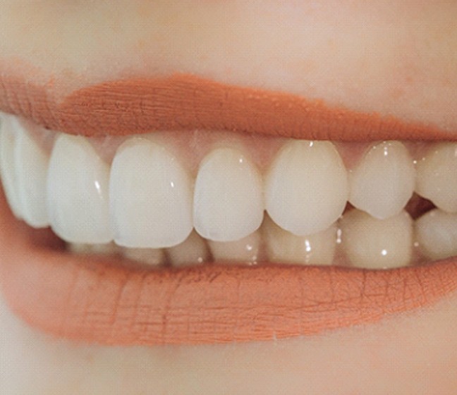 Closeup of woman smiling with veneers in Dallas