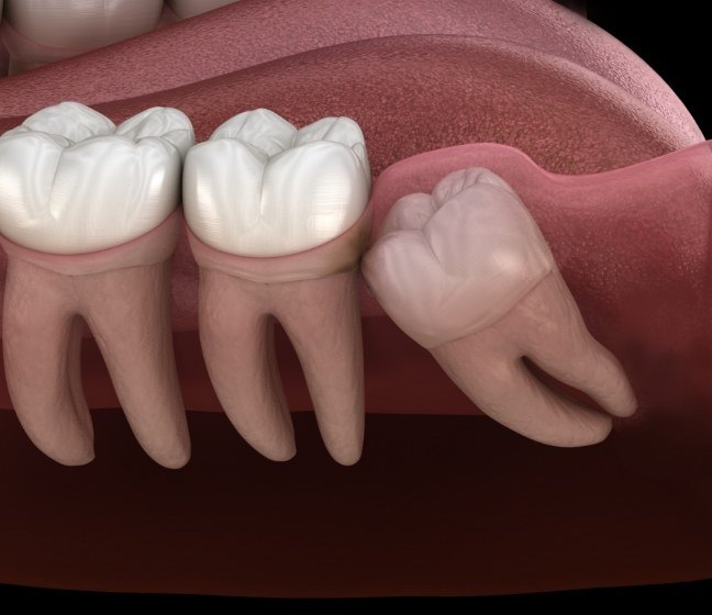 Animated smile with impacted wisdom tooth