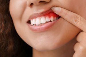 Nose to chin view of a woman pulling back her lip with her pointer finger to reveal her swollen gums