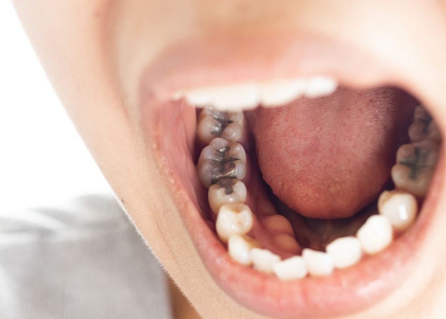 Open mouth with metal fillings